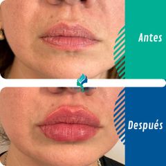 Relleno de Labios - Dr. Rodolfo Villaviencio