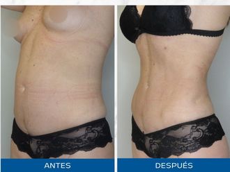 Lipoescultura antes y después - 871102