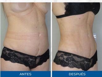 Lipoescultura antes y después - 871103