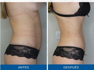 Lipoescultura antes y después - 871104