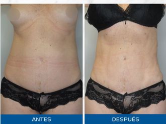 Lipoescultura antes y después - 871105