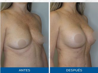 Lipoescultura antes y después - 871106