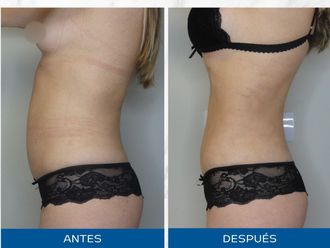 Lipoescultura antes y después - 871107