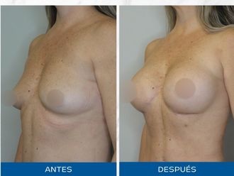 Lipoescultura antes y después - 871108