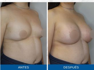 Aumento mamas antes y después - 871332