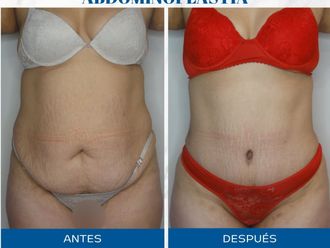 Abdominoplastía antes y después - 871511