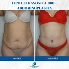 Abdominoplastia - Dr. Rodolfo Villavicencio