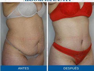 Abdominoplastía antes y después - 871512