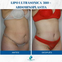 Abdominoplastia - Dr. Rodolfo Villavicencio