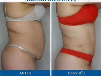 Abdominoplastía antes y después - 871513