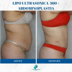 Abdominoplastia - Dr. Rodolfo Villavicencio