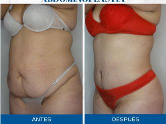 Abdominoplastía antes y después - 871514