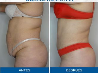 Abdominoplastía antes y después - 871515