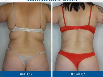 Abdominoplastía antes y después - 871516