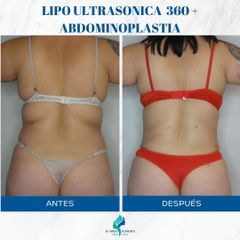 Abdominoplastia - Dr. Rodolfo Villavicencio