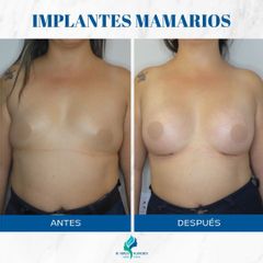 Aumento Mamas - Dr. Rodolfo Villavicencio