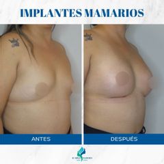 Aumento Mamas - Dr. Rodolfo Villavicencio