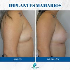 Aumento Mamas - Dr. Rodolfo Villavicencio