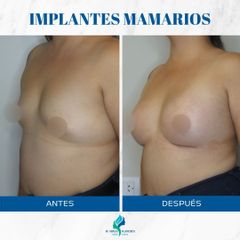 Aumento Mamas - Dr. Rodolfo Villavicencio