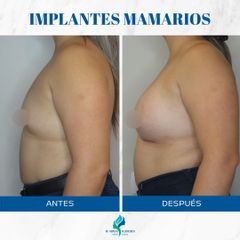 Aumento Mamas - Dr. Rodolfo Villavicencio