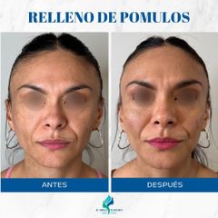 Rellenos Faciales - Dr. Rodolfo Villavicencio