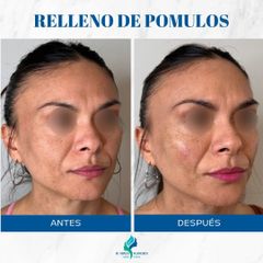 Rellenos Faciales - Dr. Rodolfo Villavicencio