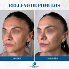 Rellenos Faciales - Dr. Rodolfo Villavicencio