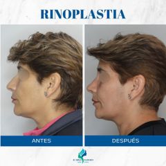 Rinoplastia - Dr. Rodolfo Villavicencio