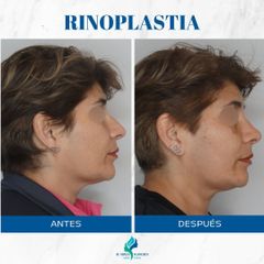 Rinoplastía - Dr. Rodolfo Villavicencio