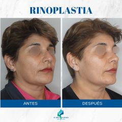 Rinoplastia - Dr. Rodolfo Villavicencio