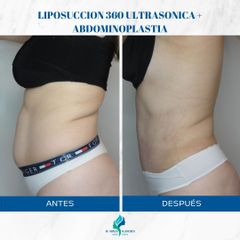 Liposucción - Dr. Rodolfo Villavicencio