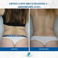 Liposucción - Dr. Rodolfo Villavicencio