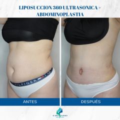 Liposucción - Dr. Rodolfo Villavicencio