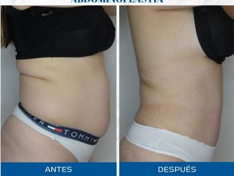 Abdominoplastía antes y después - 872243