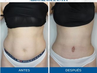 Abdominoplastía antes y después - 872244