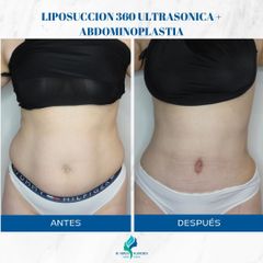 Abdominiplastia - Dr. Rodolfo Villavicencio