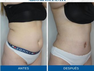 Abdominoplastía antes y después - 872245