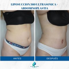 Abdominoplastia - Dr. Rodolfo Villavicencio