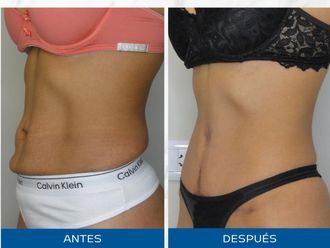 Abdominoplastía antes y después - 872544