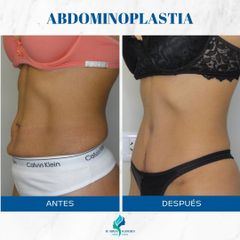 Abdominoplastia- Dr. Rodolfo Villavicencio