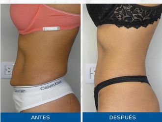 Abdominoplastía antes y después - 872545