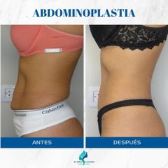 Abdominoplastia- Dr. Rodolfo Villavicencio