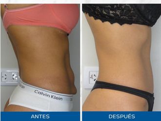 Abdominoplastía antes y después - 872546