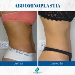 Abdominoplastia- Dr. Rodolfo Villavicencio