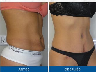 Abdominoplastía antes y después - 872547