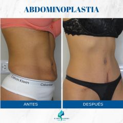 Abdominoplastia- Dr. Rodolfo Villavicencio