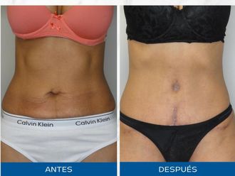 Abdominoplastía antes y después - 872548