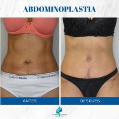 Abdominoplastia- Dr. Rodolfo Villavicencio