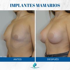 Aumento Mamario - Dr. Rodolfo Villavicencio