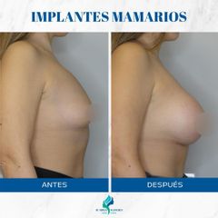 Aumento Mamario - Dr. Rodolfo Villavicencio